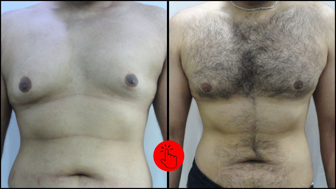 Male Breast Reduction Gallery