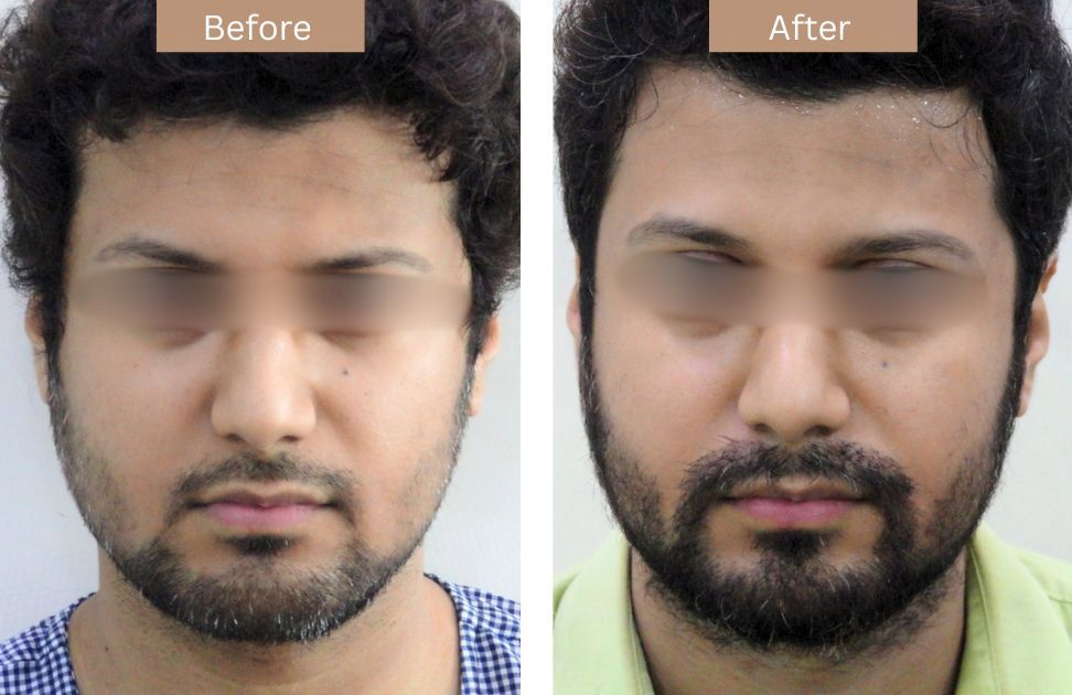 Beard Transplant Before vs After