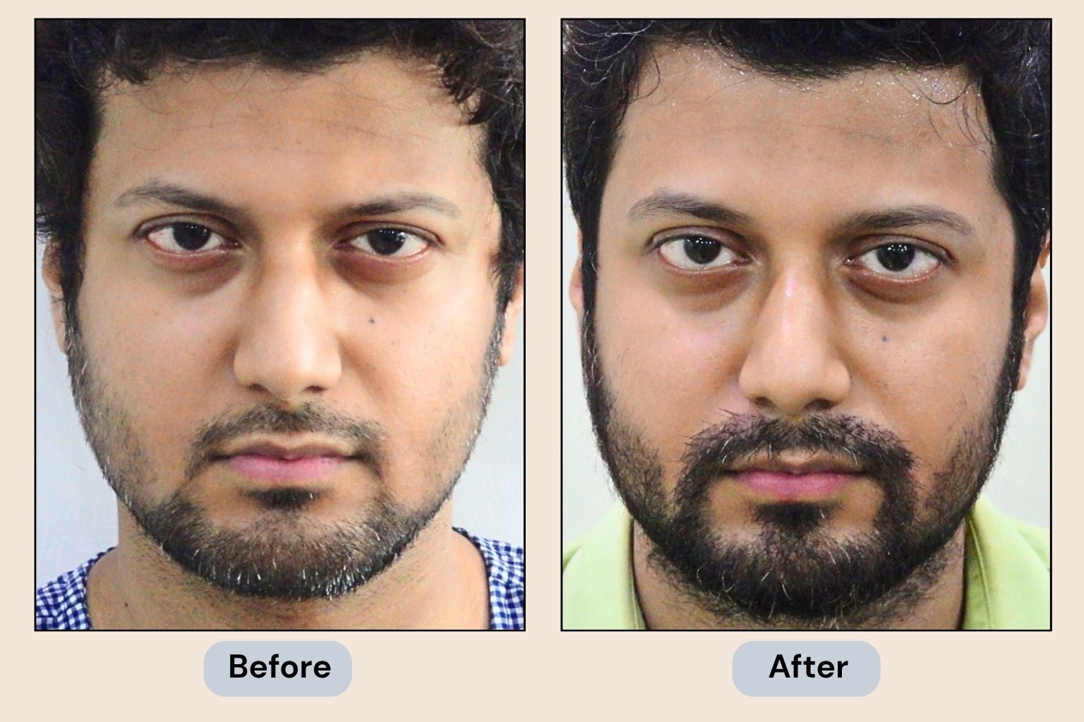 Beard Transplant Before and After