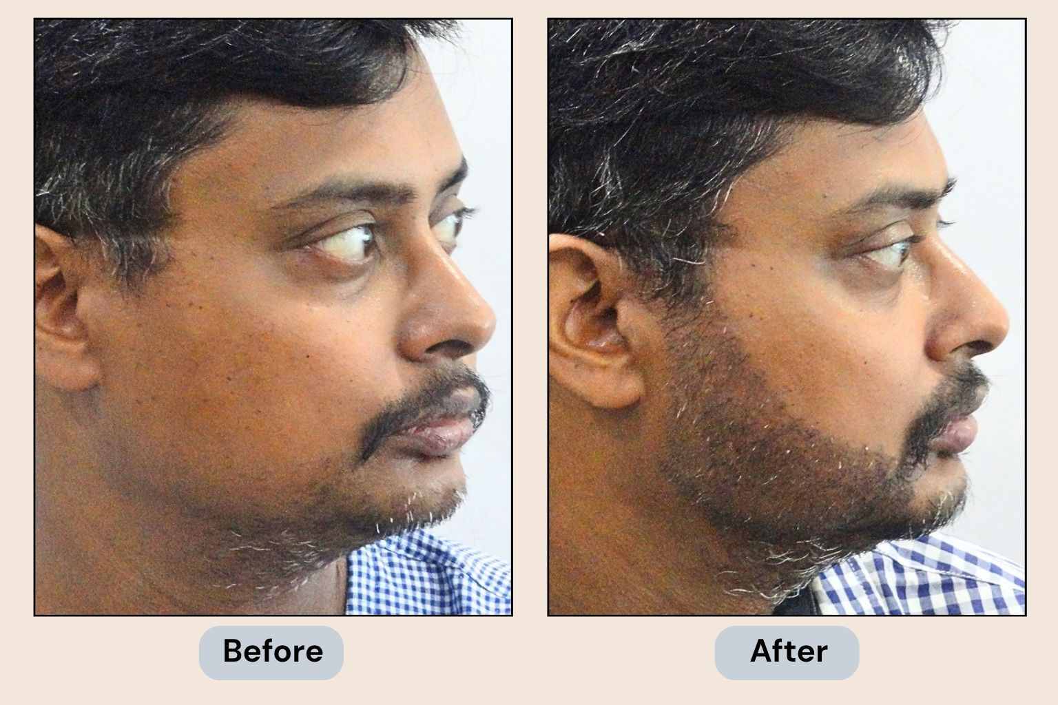 Beard Transplant