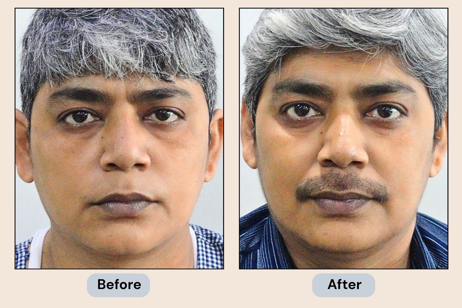 Moustache Transplant before and after