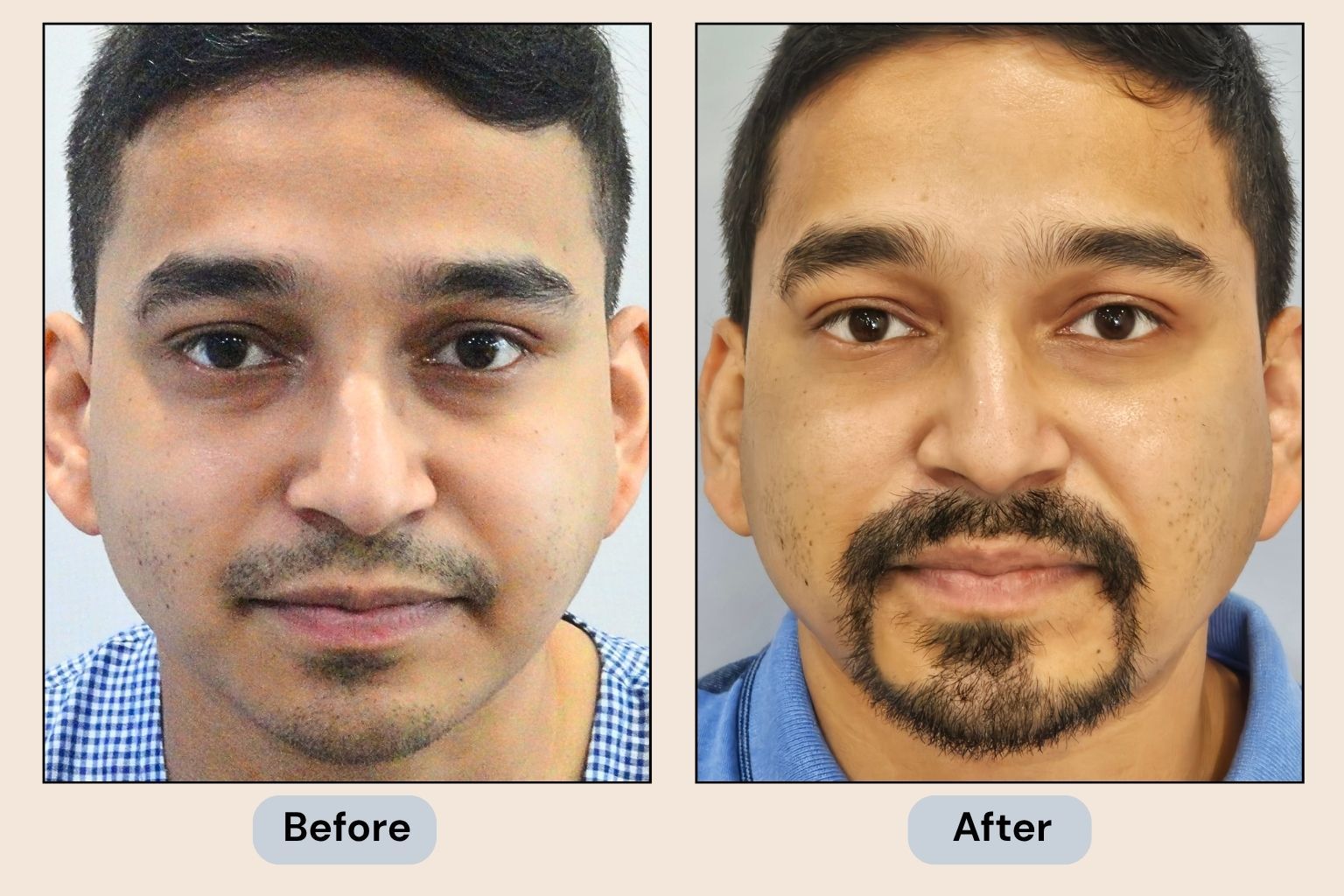 Beard and Moustache Transplant