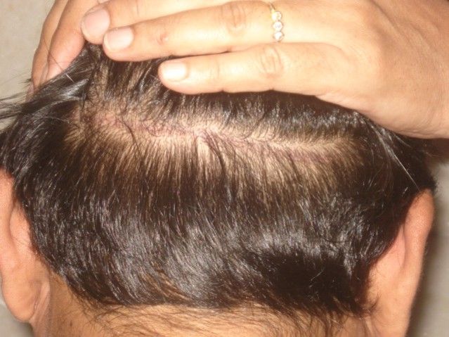 FUT Scar