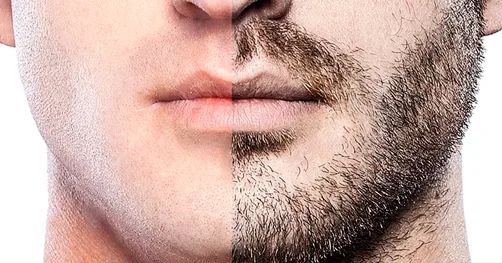 Beard Transplant