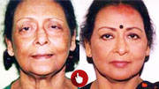 before and after face surgery